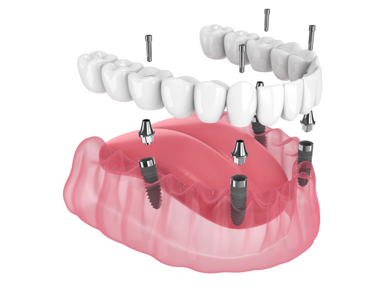 All-on-4 Dental Implants